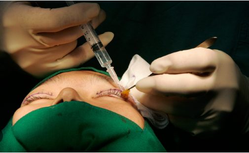 The Evolution of Surgery of Double Eyelid in New York City